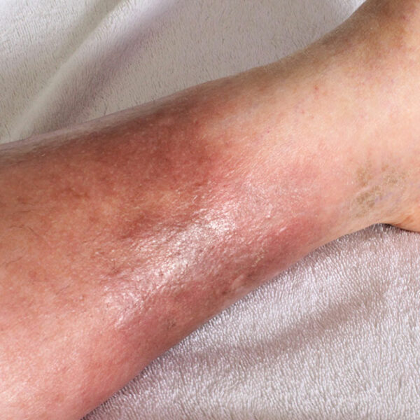 4 Ways to Prevent Deep Vein Thrombosis