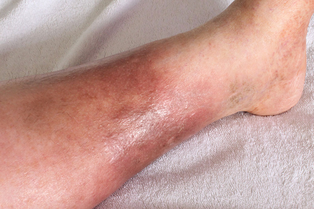 4 Ways to Prevent Deep Vein Thrombosis