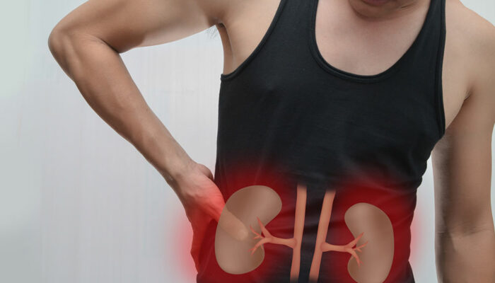 3 Signs of Renal Cancer