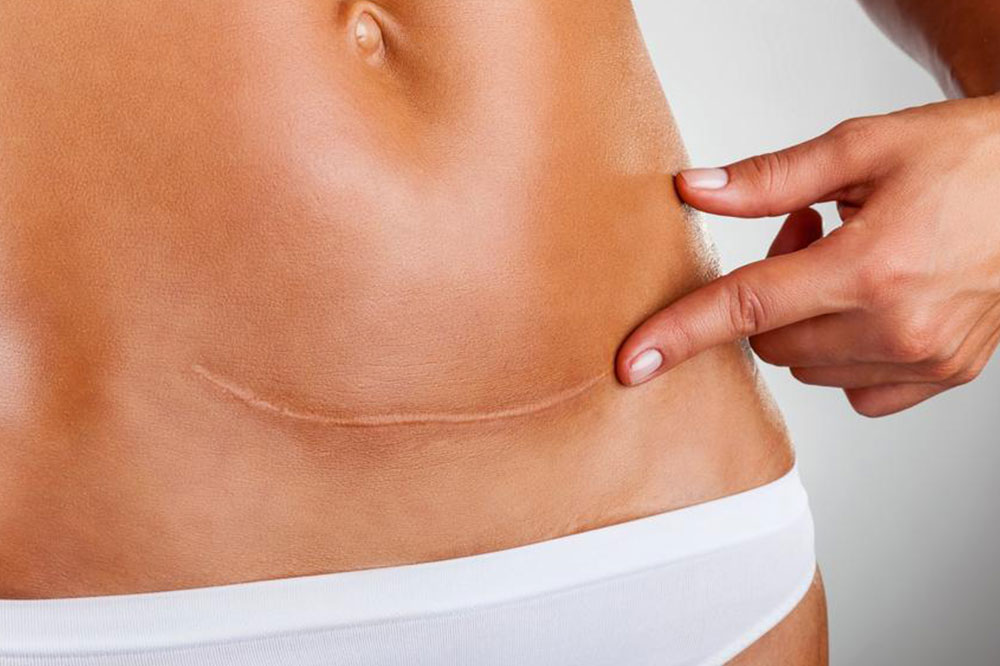 Early Warning Signs of Ovarian Cancer