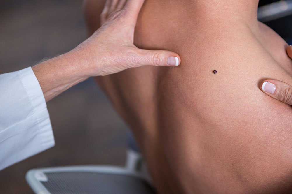 Early Warning Signs of Melanoma