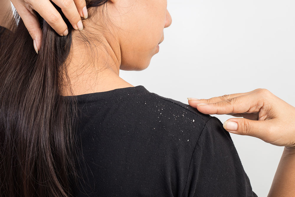 Home Remedies To Treat Dandruff