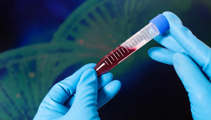 Tips to Manage Hemophilia
